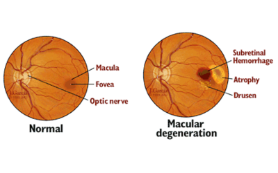 Age-Related Macular Degeneration