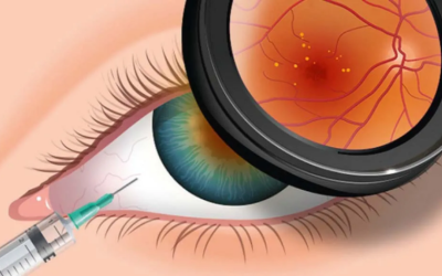 Intravitreal Injections
