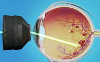 Retinal Laser Treatment